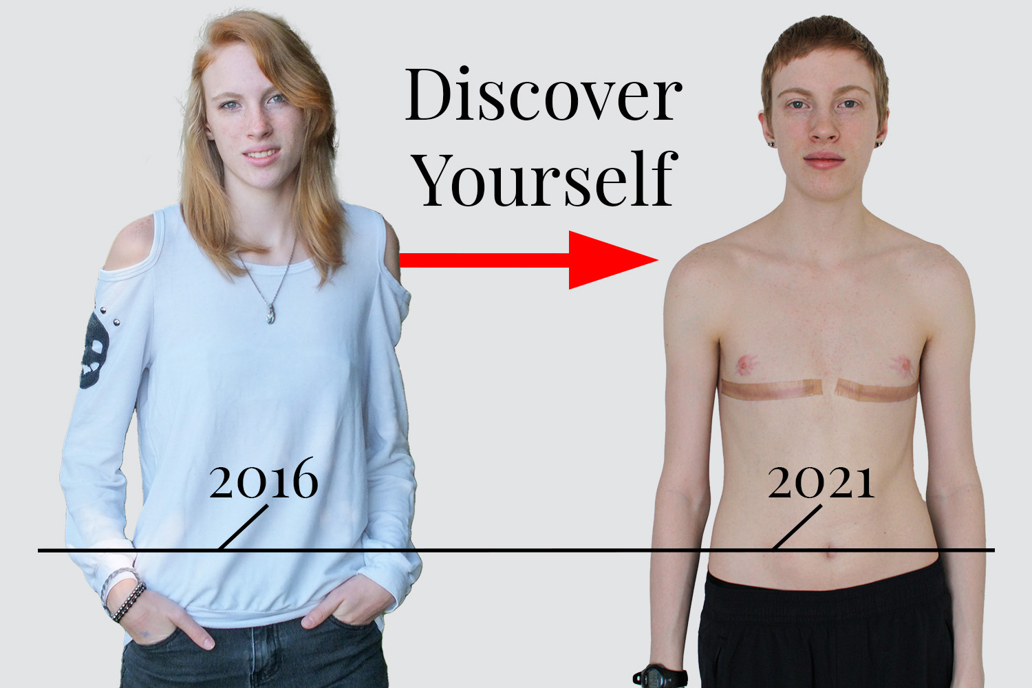 Amazing 5 Year Journey of a Transgender Man